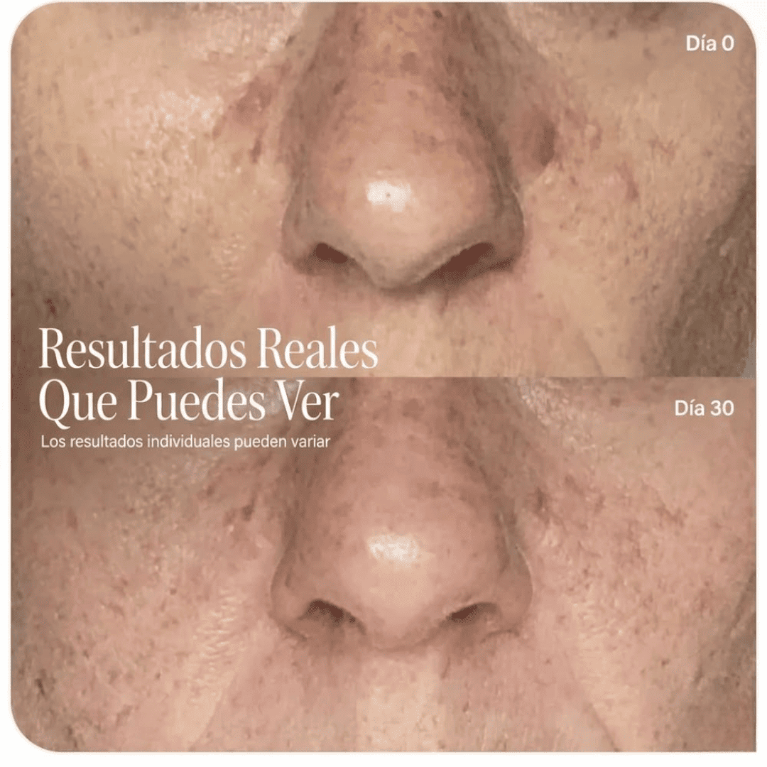 AURA - Máscara de belleza LED TERAPIA luz roja